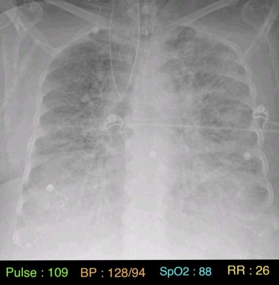 Dane życiowe pacjenta i prześwietlenie klatki piersiowej puzzle online ze zdjęcia