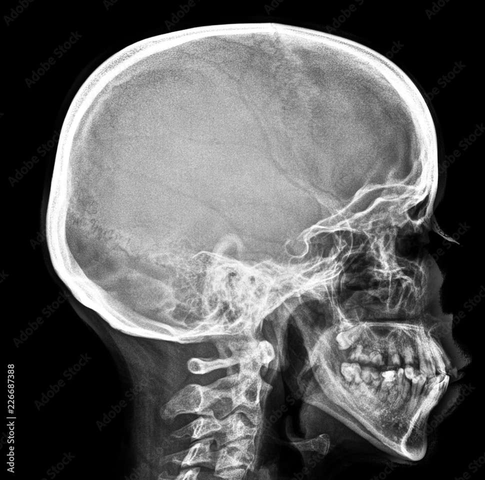 radiografia czaszki puzzle online ze zdjęcia